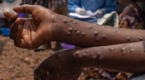 Ministry Of Health Issues Alerts As Kenya Reports 314 Mpox Cases Nationwide