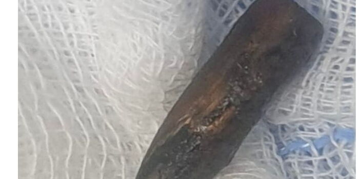 Bullet Removed After Protester’s 14-Month Wait