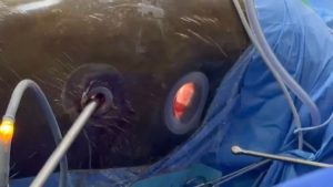KNH Makes Medical History With Kenya’s First Minimally Invasive Esophagectomy