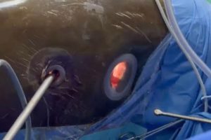 KNH Makes Medical History With Kenya’s First Minimally Invasive Esophagectomy